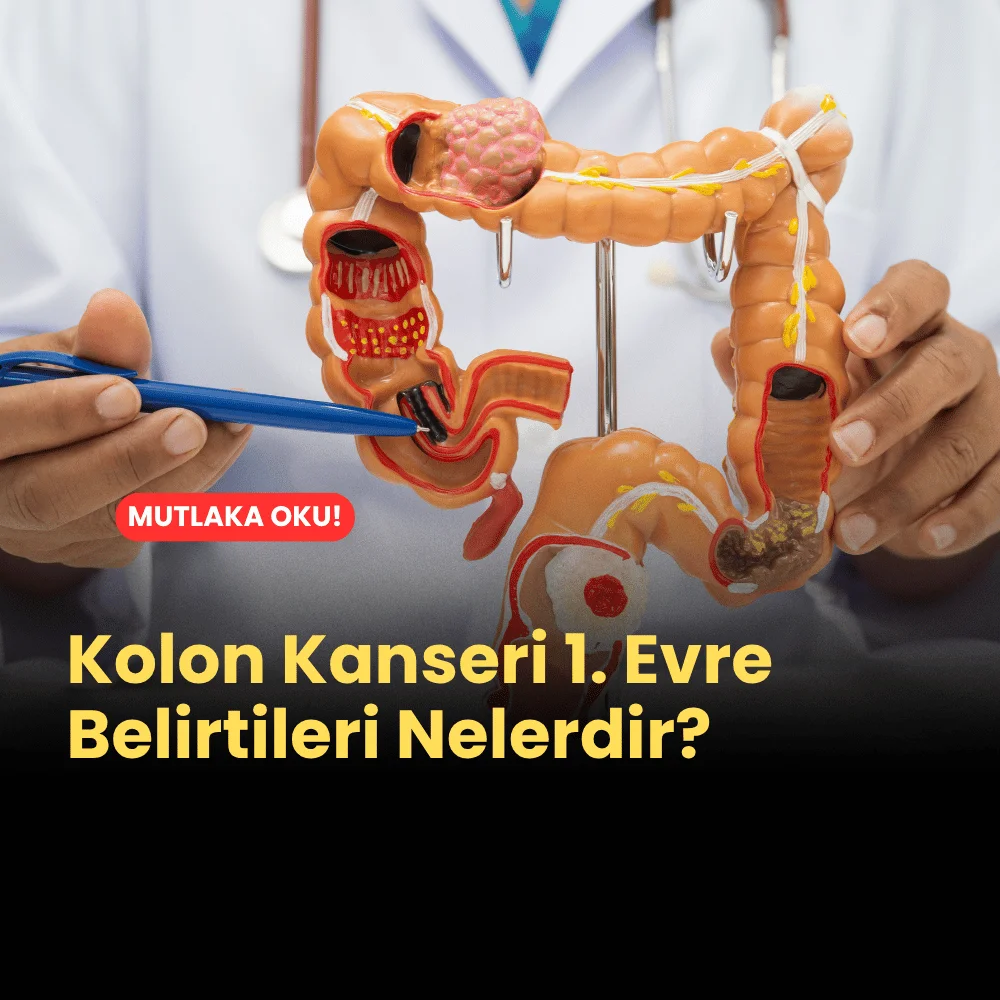 Kolon Kanseri 1. Evre Belirtileri Nelerdir