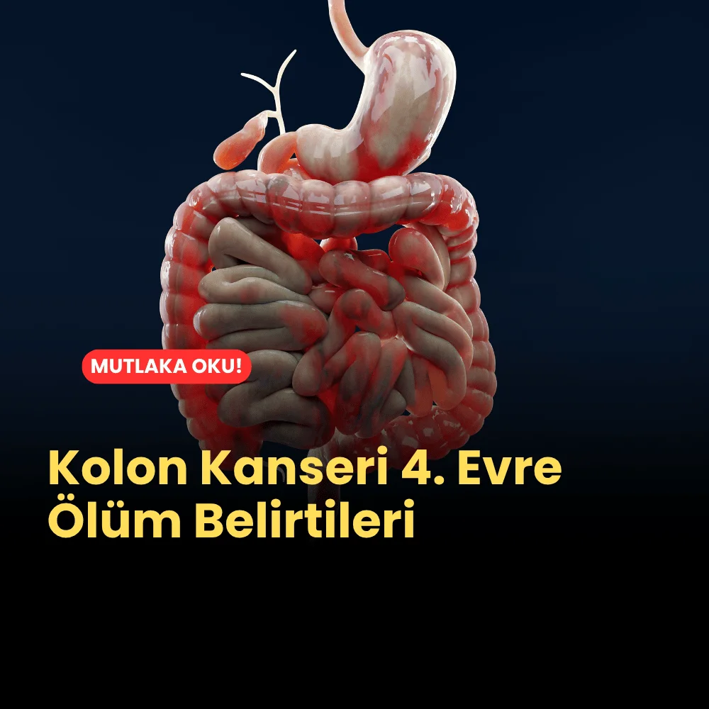 Kolon Kanseri 4. Evre Ölüm Belirtileri