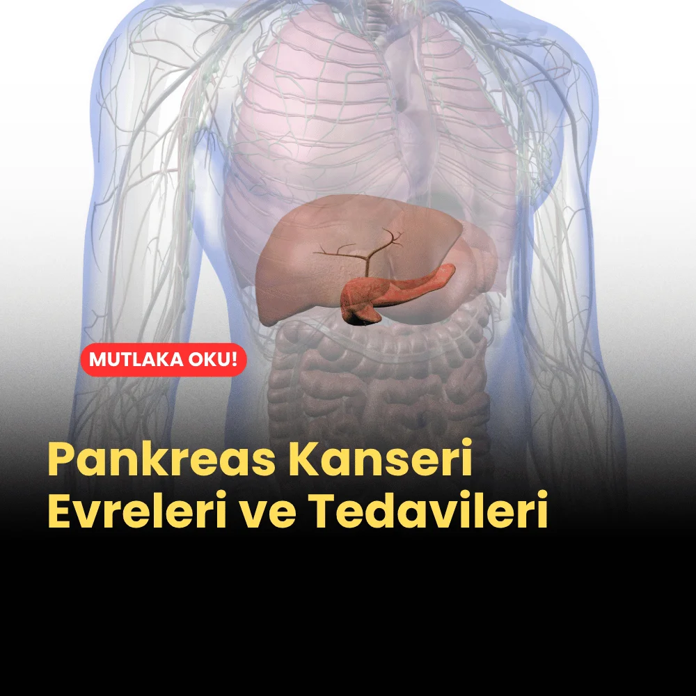 Pankreas Kanseri Evreleri ve Tedavileri